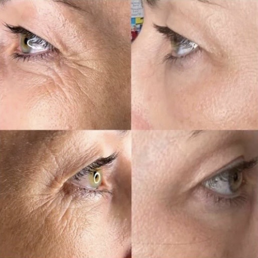 Fibroblast Plasma Lift result — eye area lift and smoothing