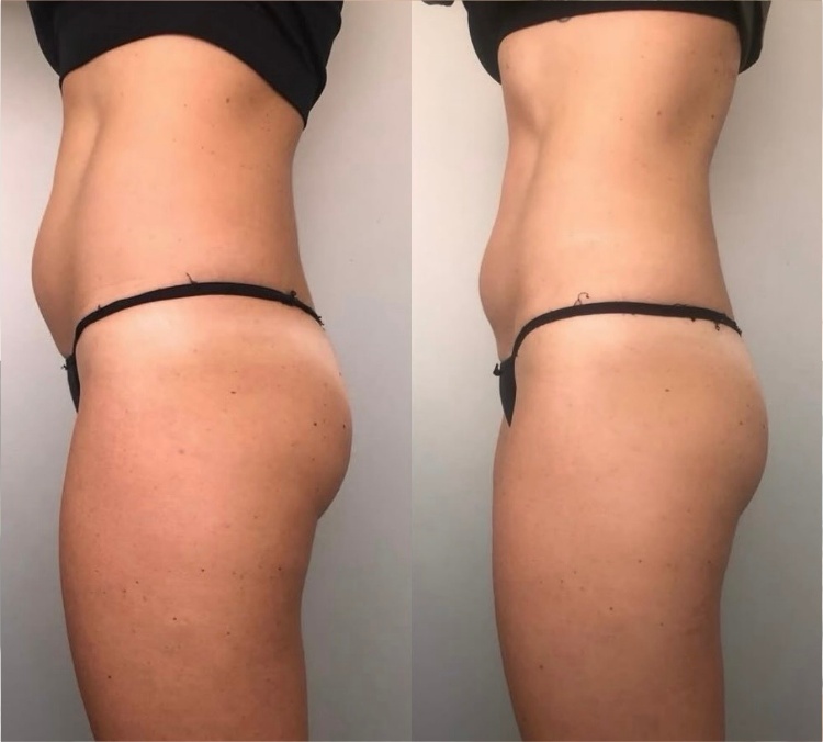 HIFU Tummy result — side profile before and after
