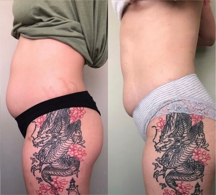 HIFU Tummy result — abdomen tightening before and after