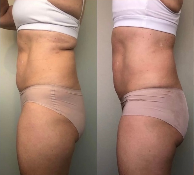 HIFU Tummy result — waistline contouring before and after