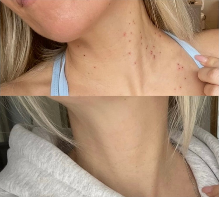 Plasma Pen result — neck and décolletage smoothing before and after