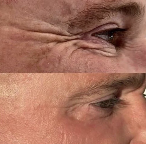 Fibroblast Plasma Lift result — crow's feet softened