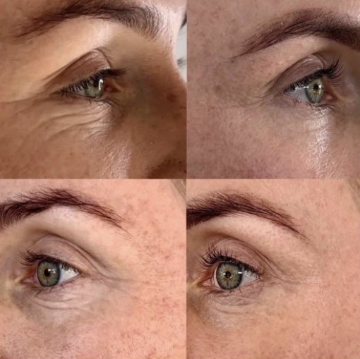 Fibroblast Plasma Lift result — under-eye refinement