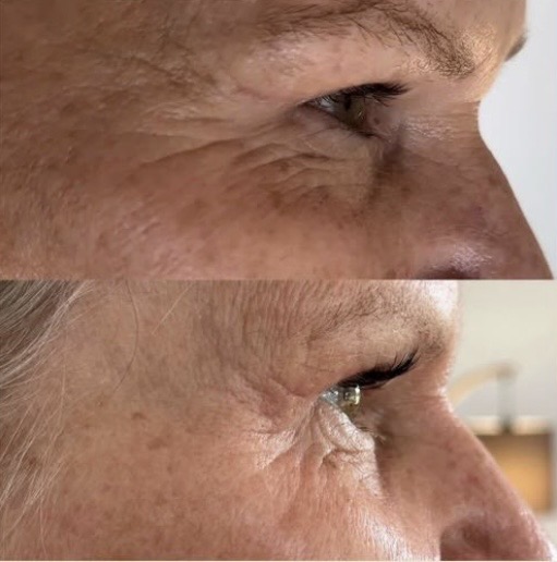 Fibroblast Plasma Lift result — upper lid tightening