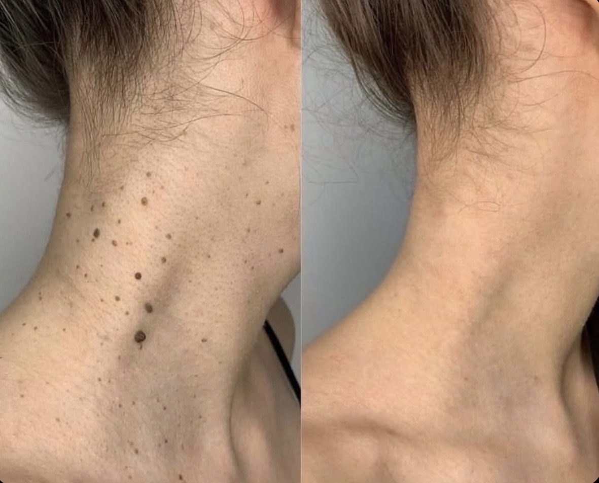 Plasma Pen result — neck skin tags and texture refinement before and after