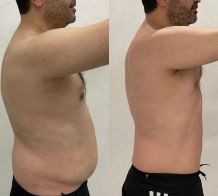 Coolslimming Ultimate 360 result — abdomen before and after
