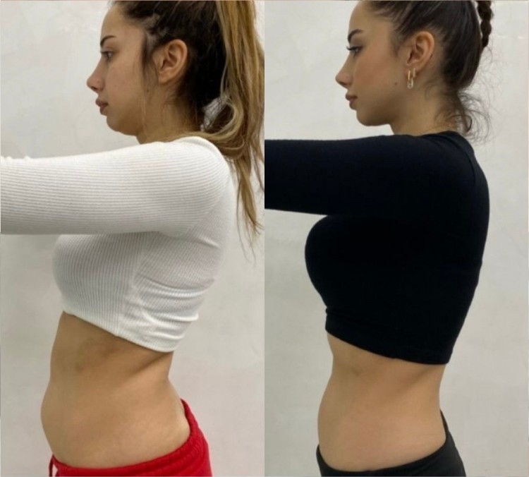 Coolslimming Ultimate 360 result — waistline contouring