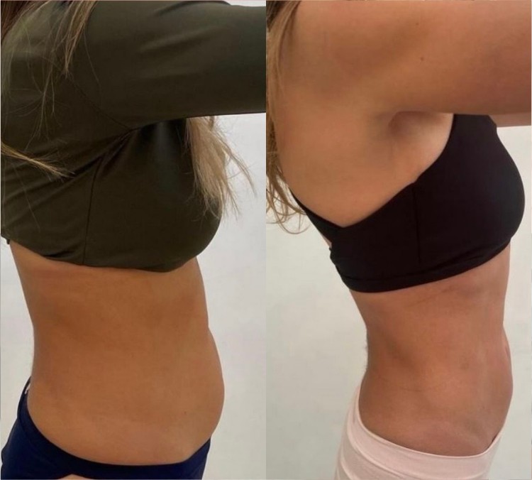 Coolslimming Ultimate 360 result — side profile slimming