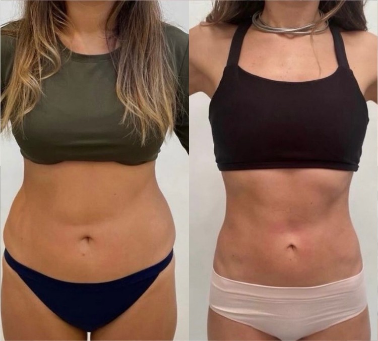 Coolslimming Ultimate 360 result — male abdomen fat reduction