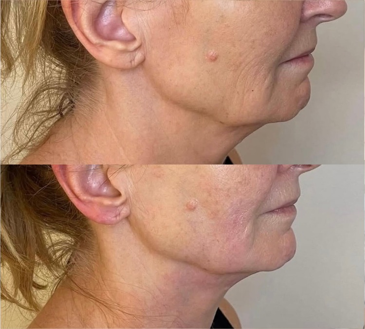 HIFU Neck result — jawline and neck lift before and after
