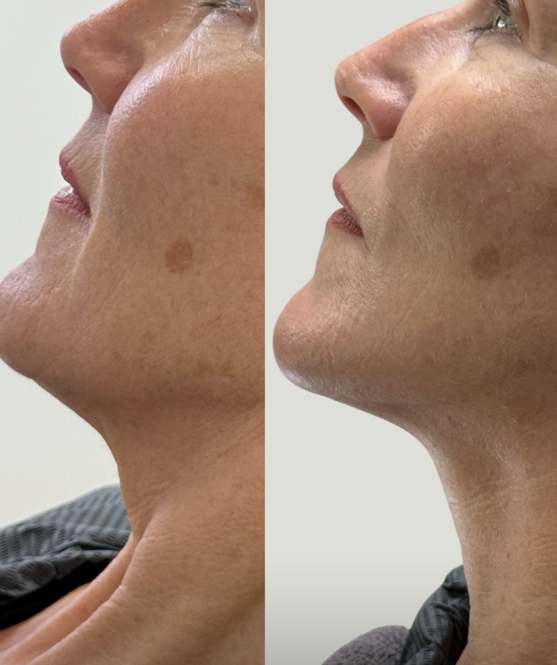 HIFU Neck result — chin and neck contour before and after
